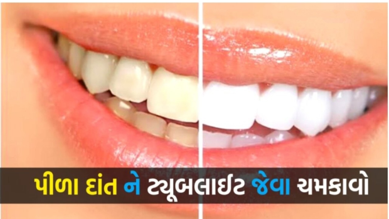 Simple home remedies to whiten yellow teeth